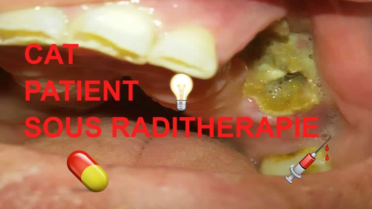 Conduite à tenir devant un patient sous radiothérapie .#dentist #radiotherapy #dentistry