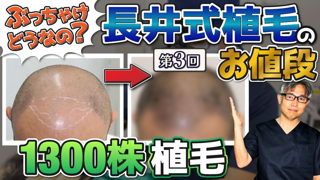【ここまで治るの！？】高難易度の植毛の結果をご紹介③