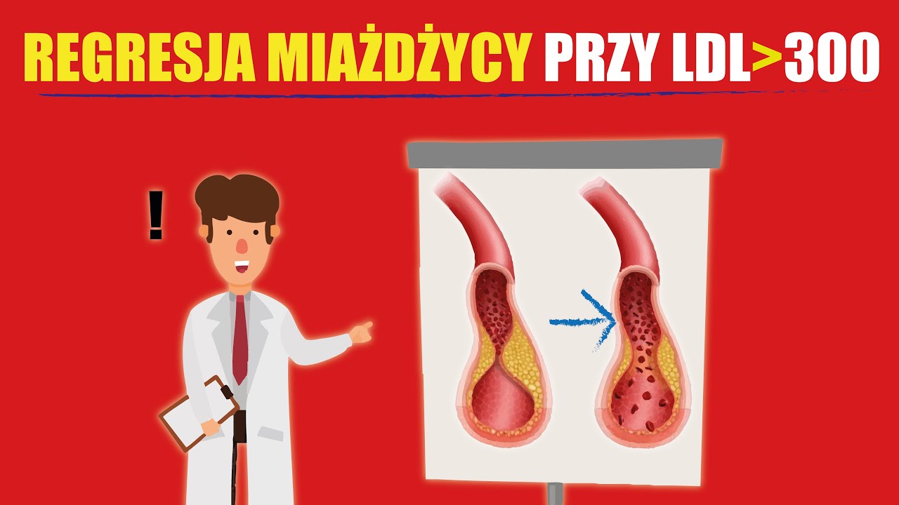 KETO-CTA: grabarz dogmatu &bdquo;LDL powoduje zawały&rdquo;