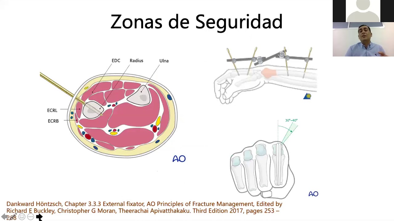 TODO ORTOP&Eacute;DICO   JORNADA 1   PRIMER CURSO B&Aacute;SICO ONLINE DE FIJACI&Oacute;N EXTERNA   08 07 2020