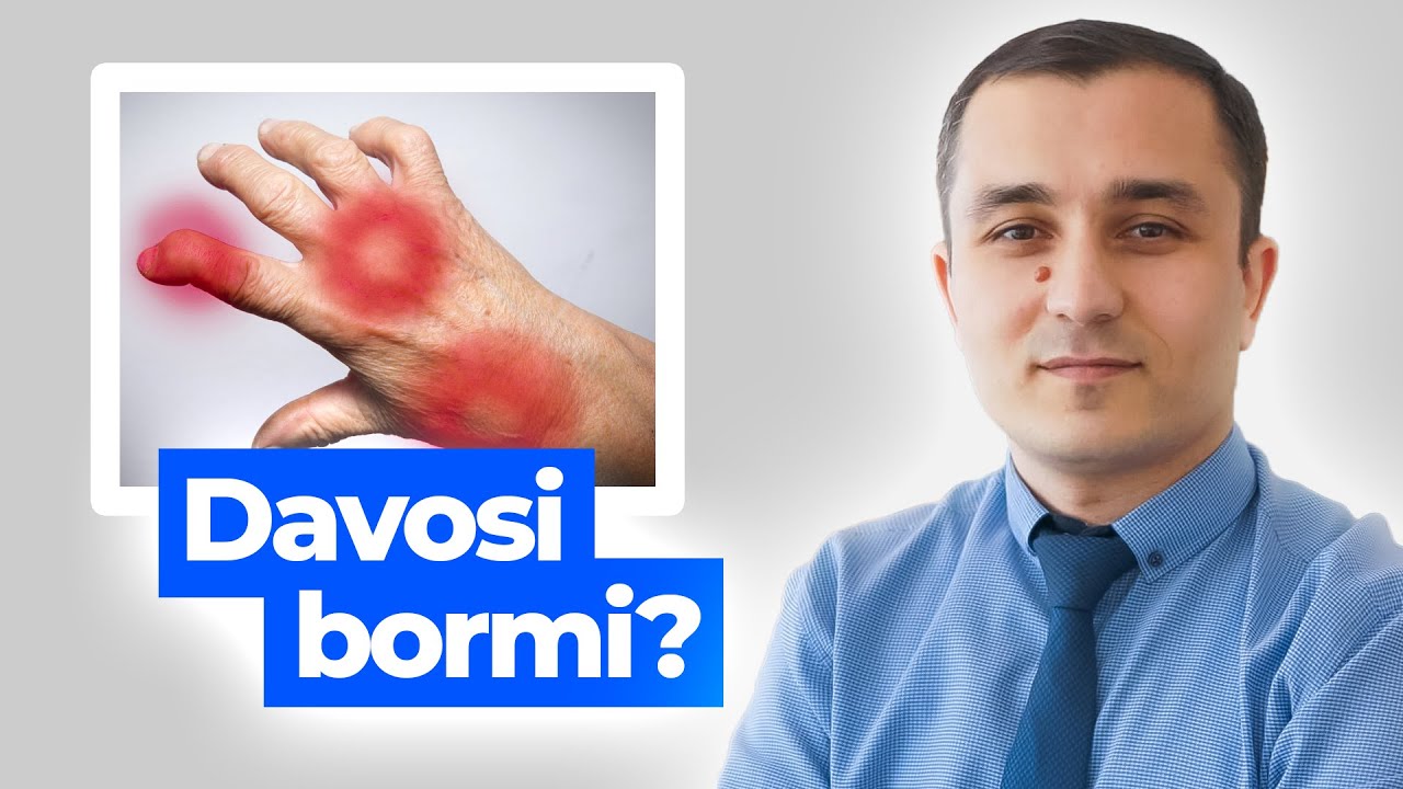 Poliartrit davosi bormi? Poliartrit haqida bilib oling!