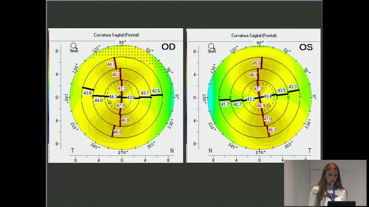 Dra. Maria Alejandra Henriquez (Perú): Queratocono: Diagnostico, estadiaje y progresión.