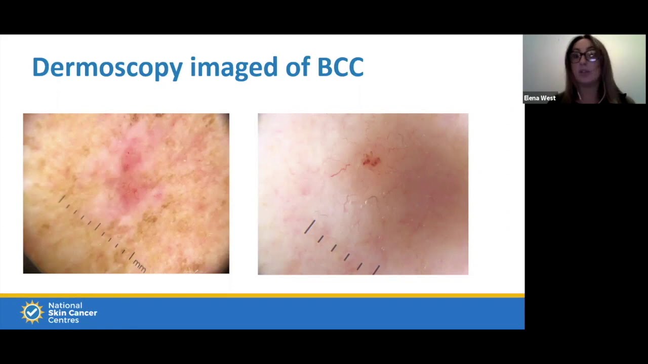 Skin Cancer Training for Patients - National Skin Cancer Centres