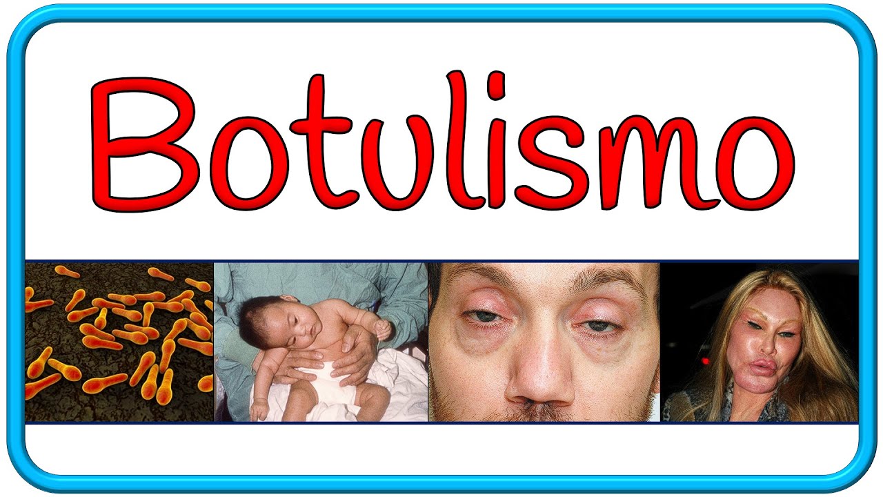 BOTULISMO - fisiopatología, microbiología, signos y síntomas, diagnóstico, tratamiento y prevención
