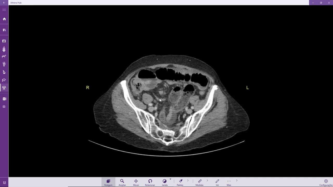 Obstrução intestinal