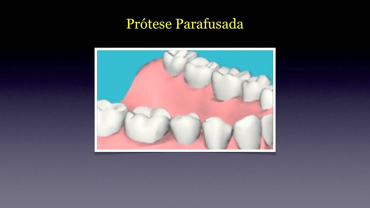Pr&oacute;tese Parafusada x Cimentada