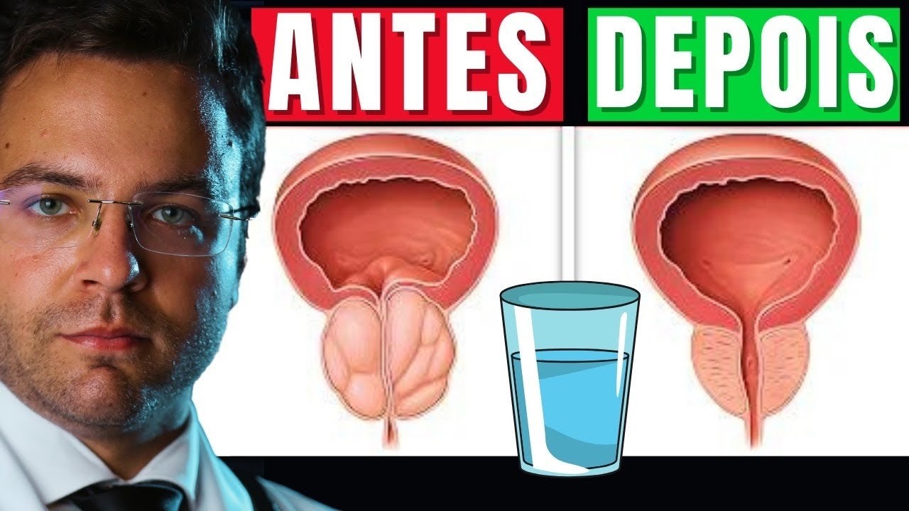 Apenas UM COPO AO DIA para DIMINUIR sua PRÓSTATA AUMENTADA