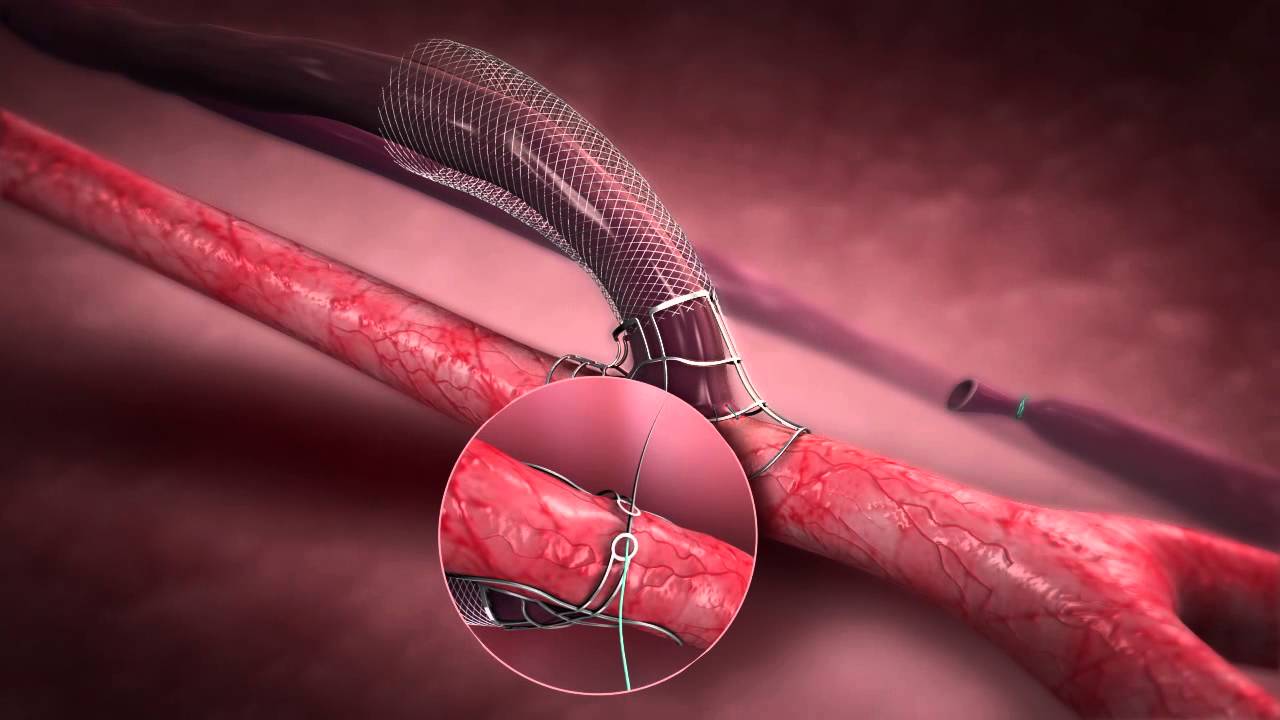 Laminate Medical Technologies - VasQ Device