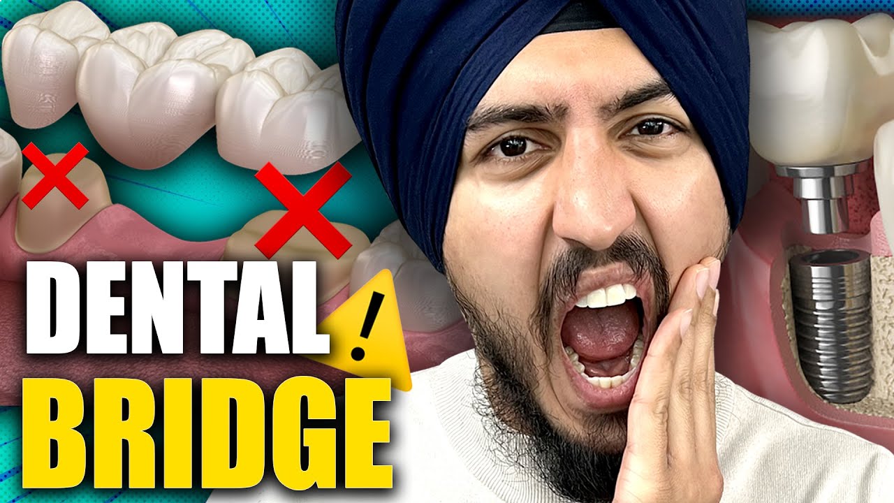 5 Reasons Why You Should NEVER Get a Dental Bridge! - Dentist Explains