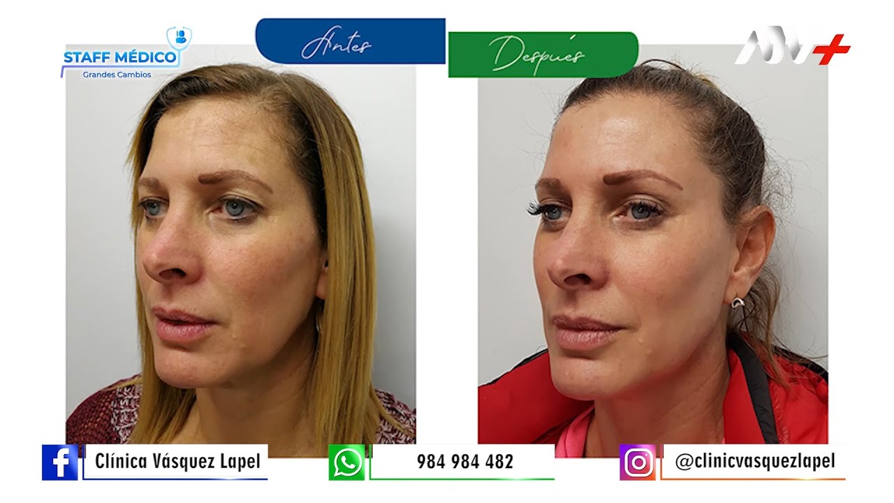 ✨¡Olvídate de las manchas, líneas de expresión y arrugas, #LáserCO2Fraccionado - DR. VÁZQUEZ LAPEL