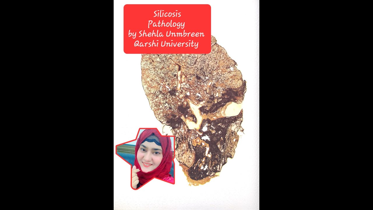 SILICOSIS