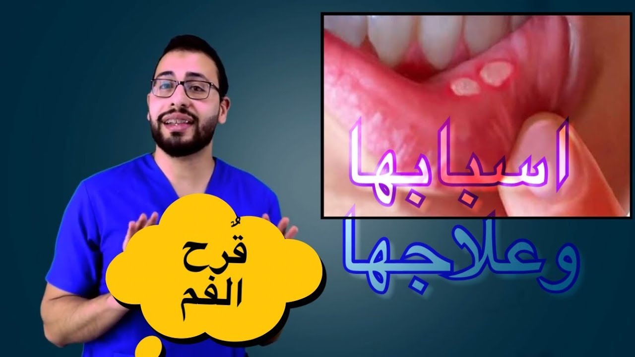 ❓كيف تتخلصون من تقرحات الفم ؟! و طرق تجنب الاصابة بها ؟؟