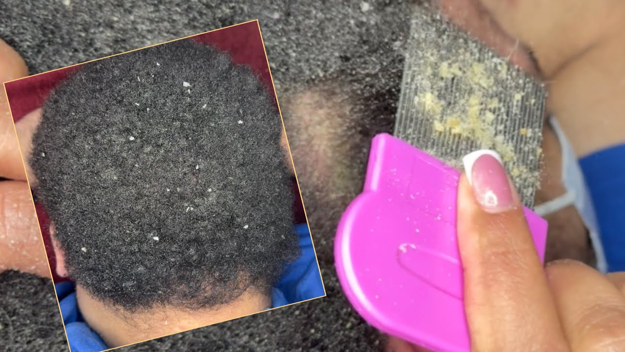 ASMR Dandruff Scratching | Combing out Matted Hair & Scalp Massage