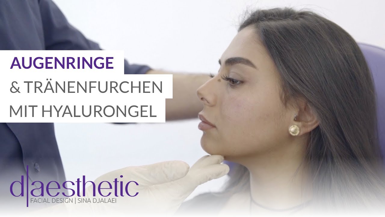 Behandlung von Augenringen und Tränenfurchen | Behandlung mit Hyalurongel -  d-aesthetic