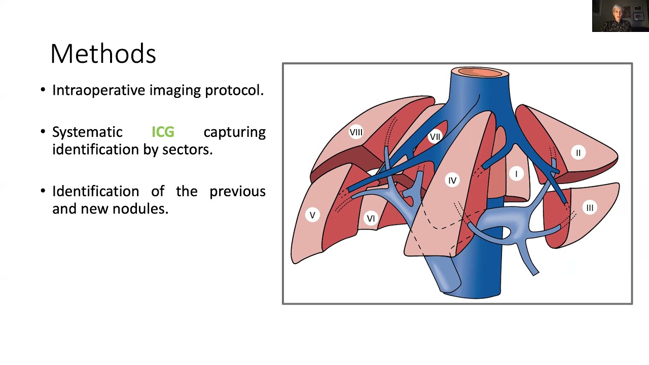 PREOPERATIVE INDOCYANINE GREEN INFUSION FOR IMAGING GUIDED SURGERY IMPROVES DETECTION OF INTRAOPERAT