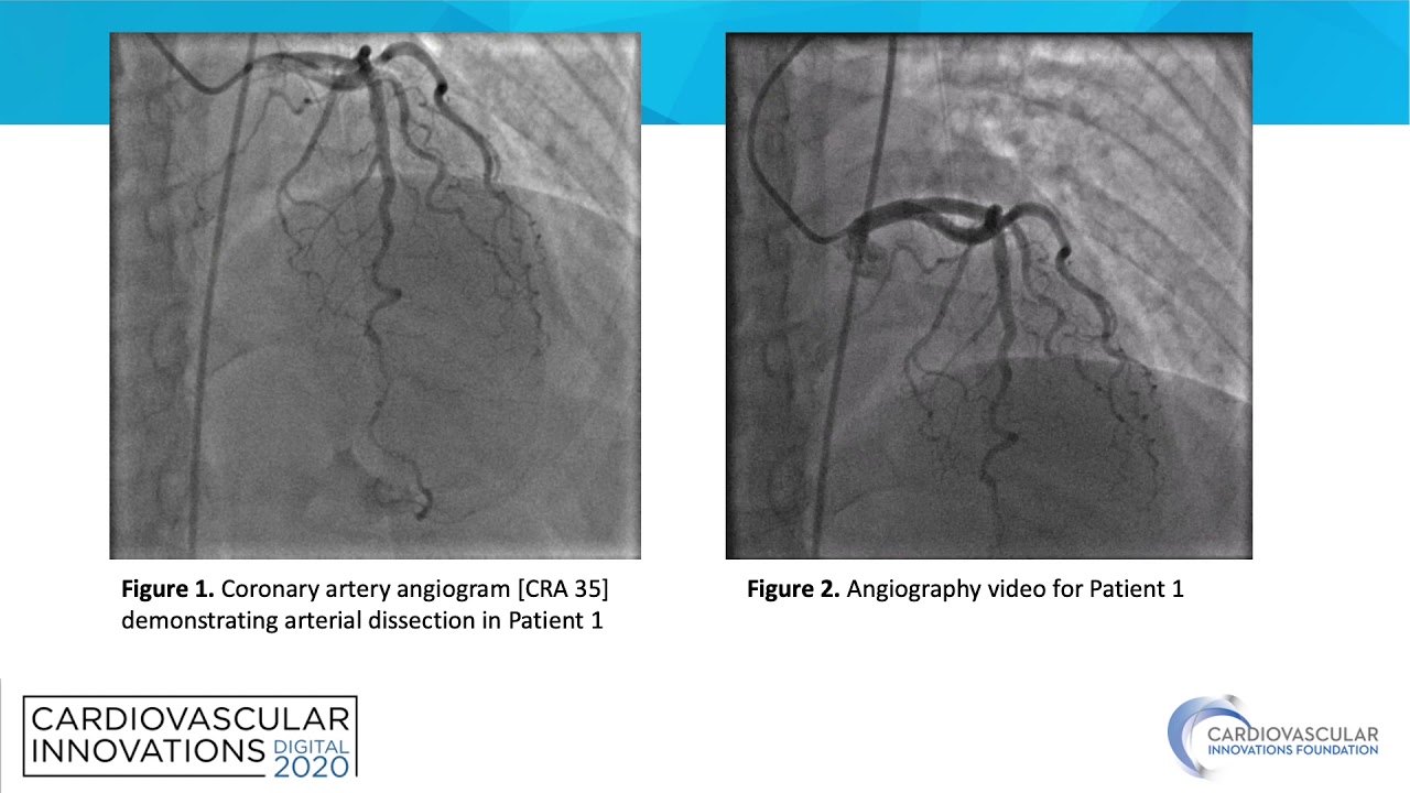 Rao_Angiography and Treatment of SCAD in Female Patients_Coronary Case
