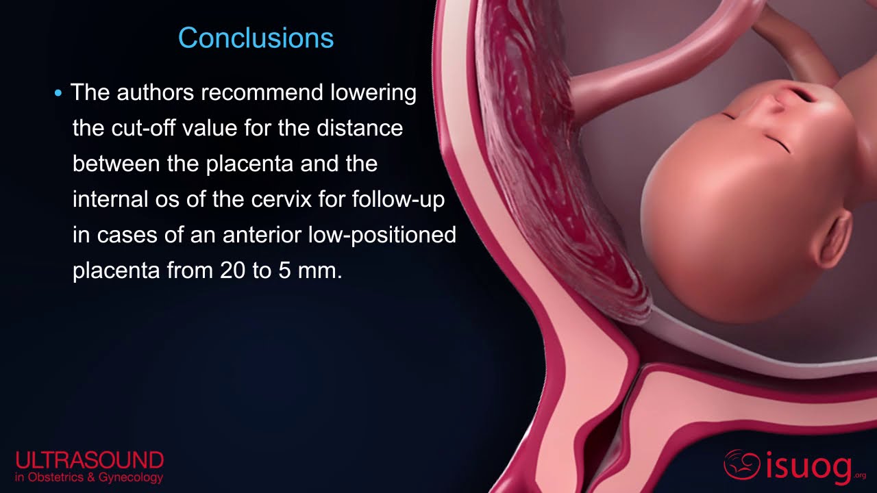 New UOG video abstract on placenta previa and low‐lying placenta second trimester ultrasound