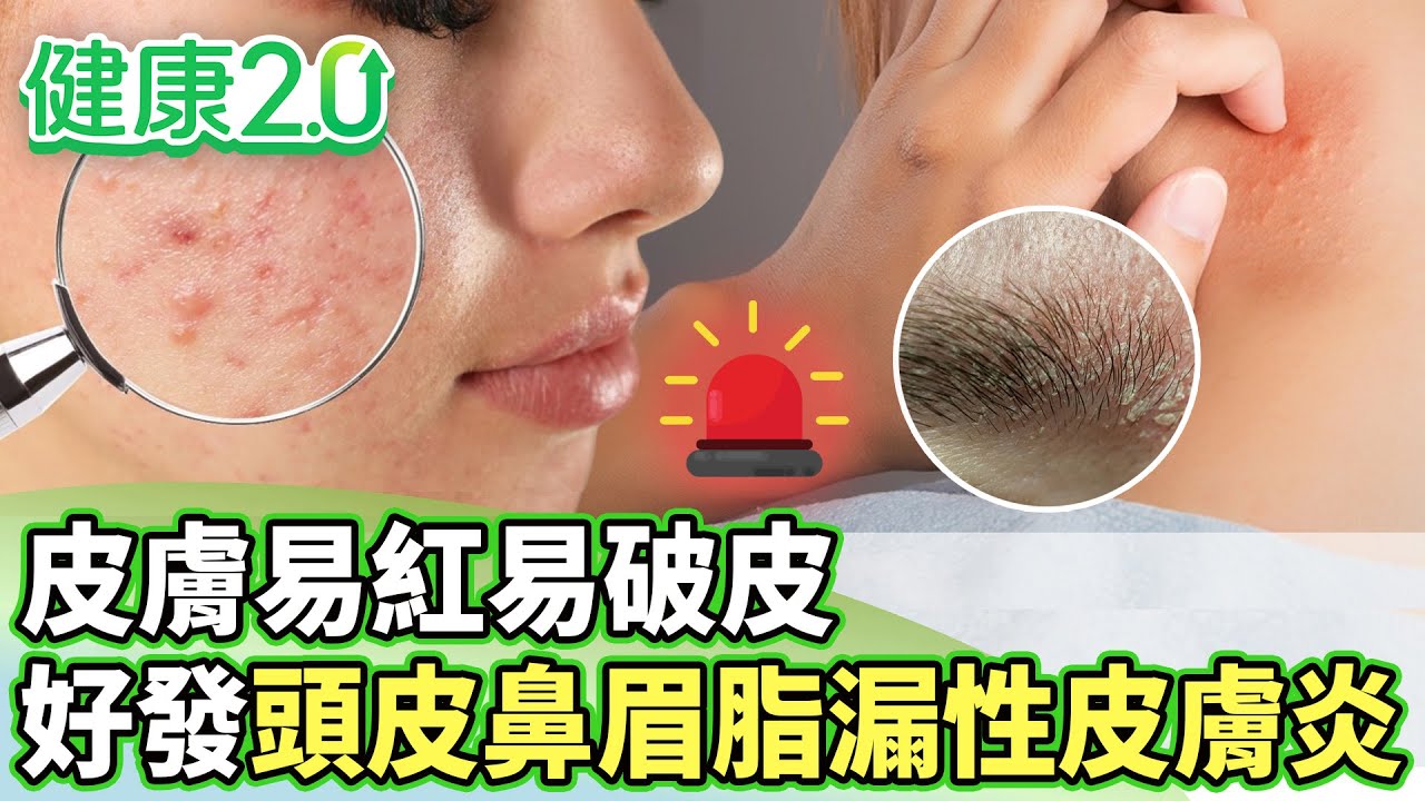 皮膚易紅易破皮 好發頭皮鼻眉多脂漏性皮膚炎【健康2.0分段】