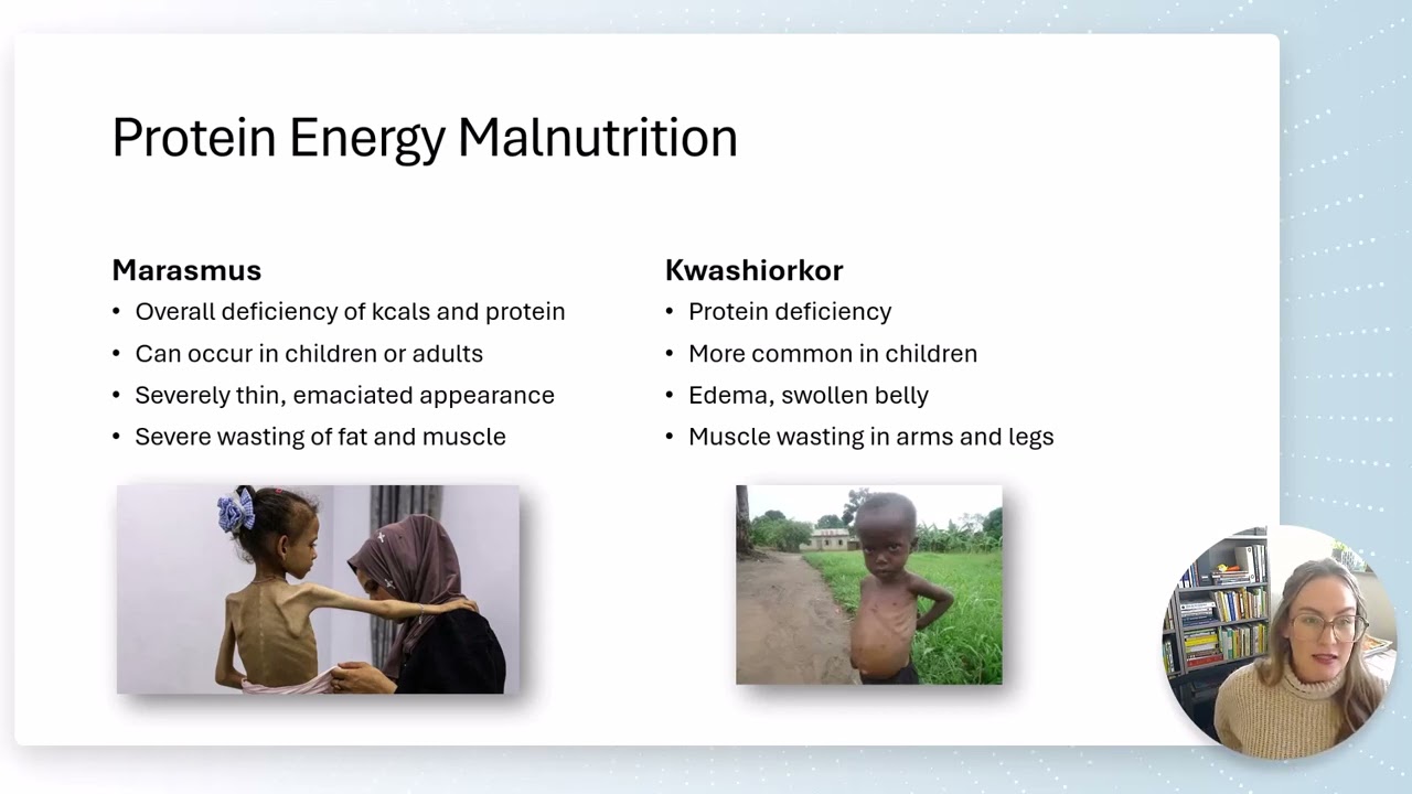 Global Nutrition and Malnutrition