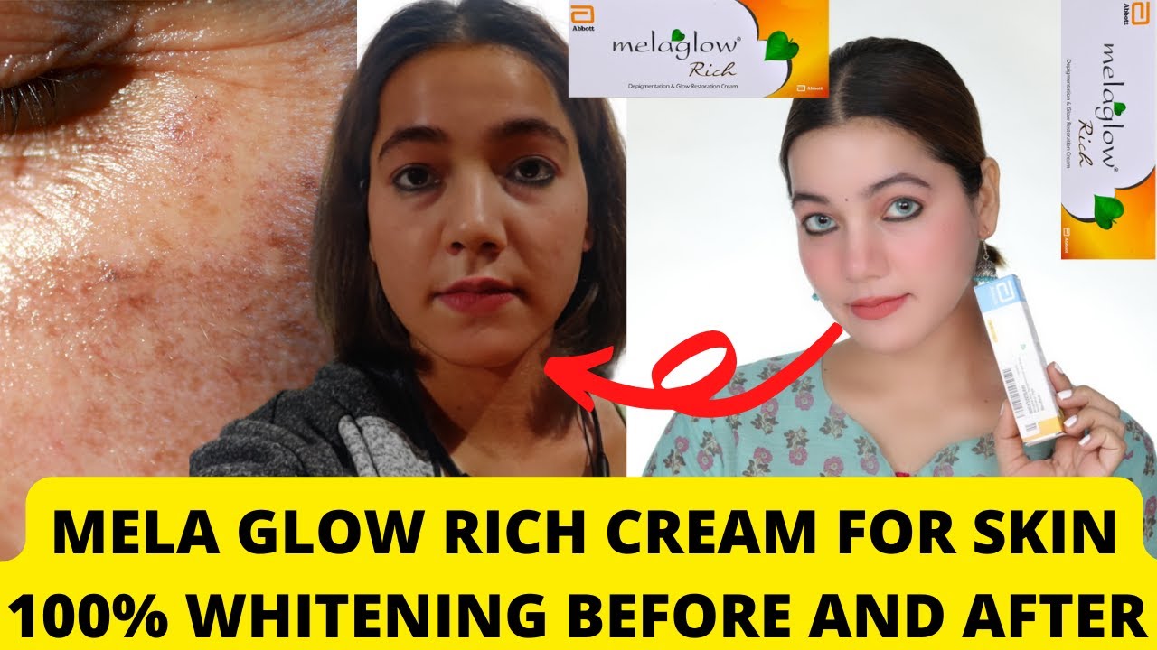 I tried Melaglow Rich Magical Skin Whitening Cream- Shocking Results Pigmentation Spots Removal
