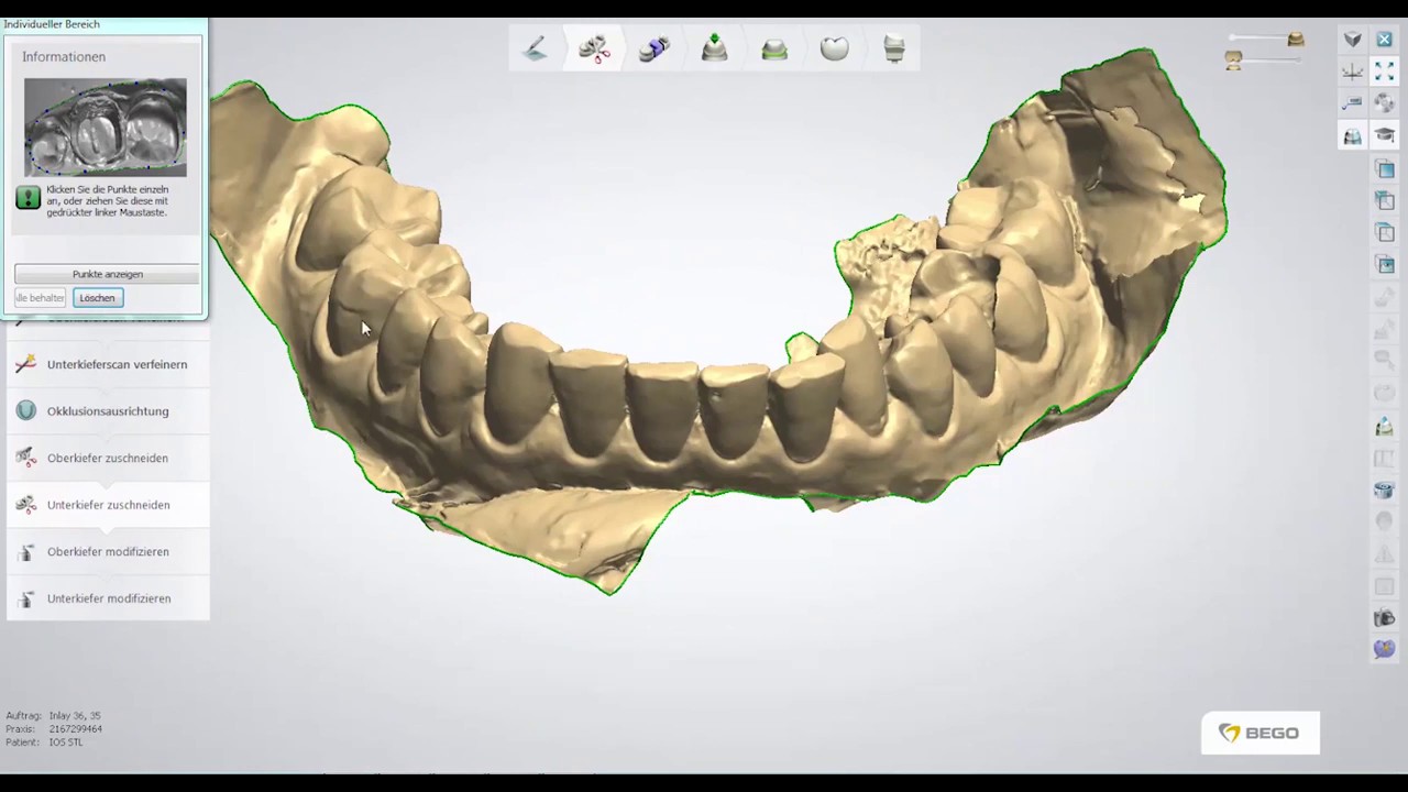 Verarbeitung von Intraoralscan-Daten (STL Files) mit dem 3Shape K&B und Model Builder