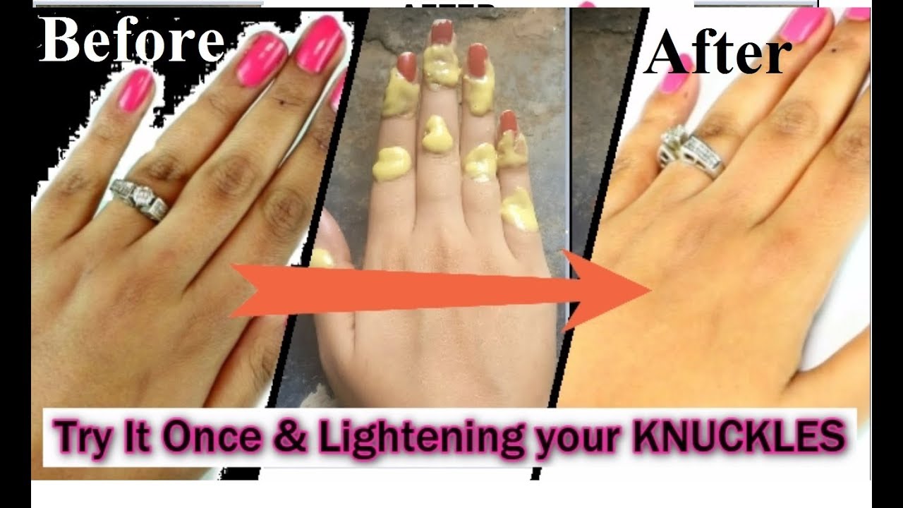 उंगलियों के जोड़ों की काली त्वचा से छूटकारा पाए | Lightening your KNUCKLES / Finger Joints