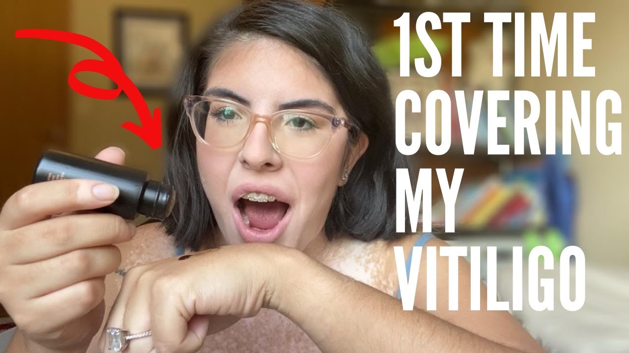 First Time Trying Zanderm Vitiligo Camouflage : SimplyGaby