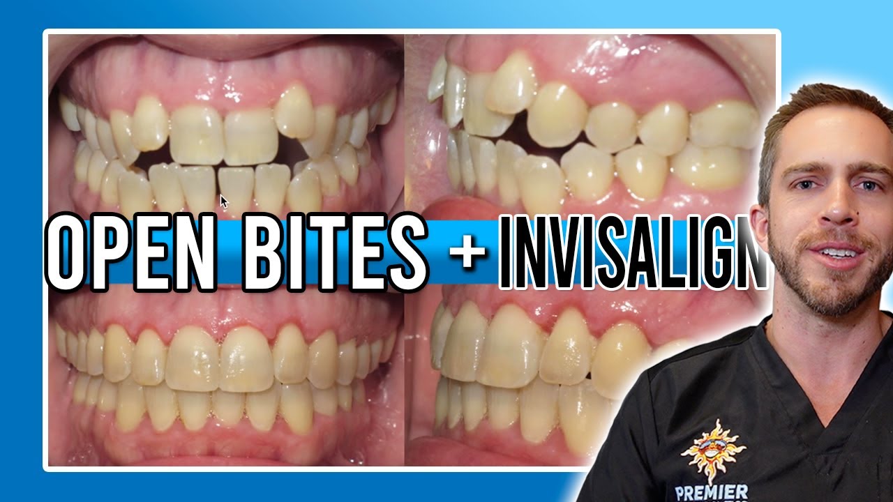 Лечение открытого прикуса Invisalign! [ДО И ПОСЛЕ]
