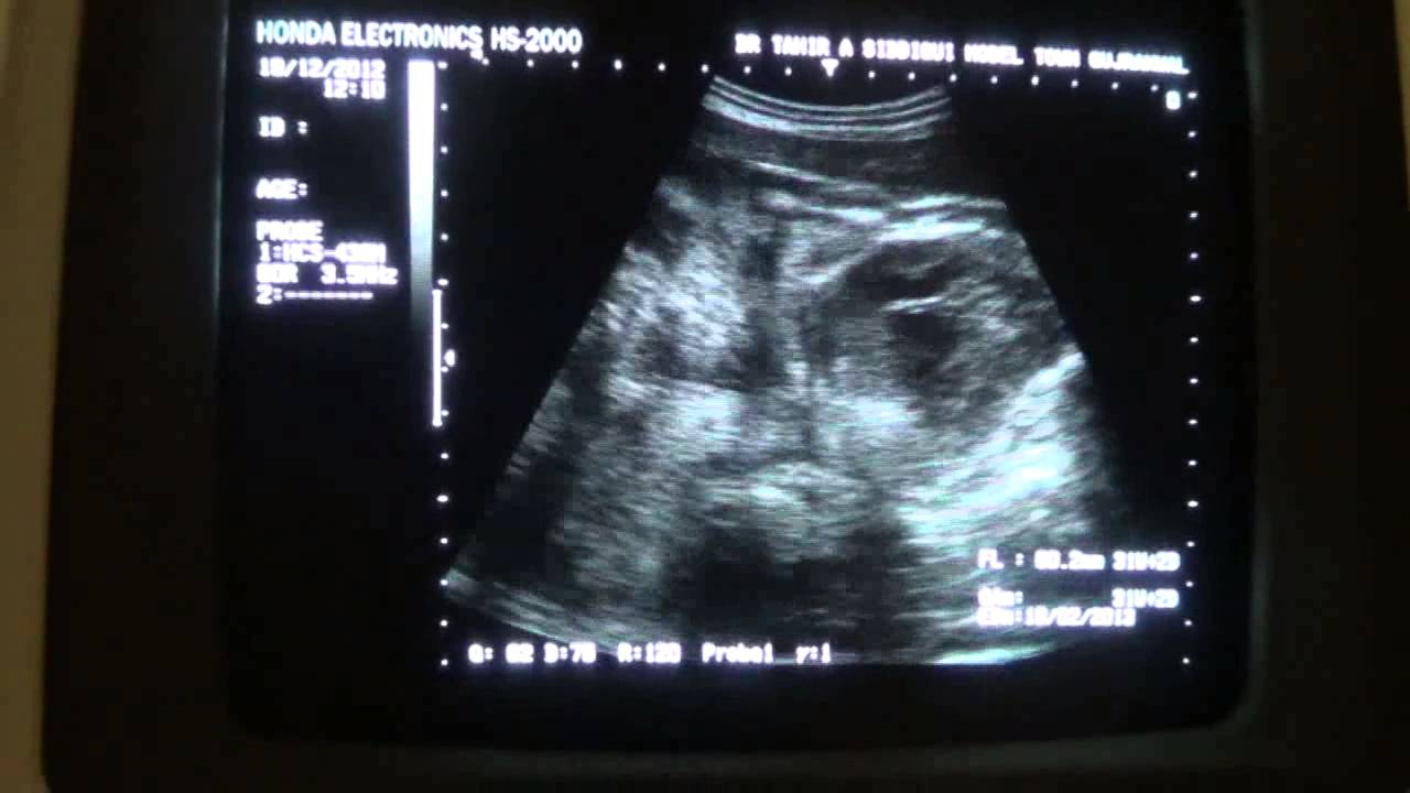 Twin pregnancy ONE alive 2nd DEMISE
