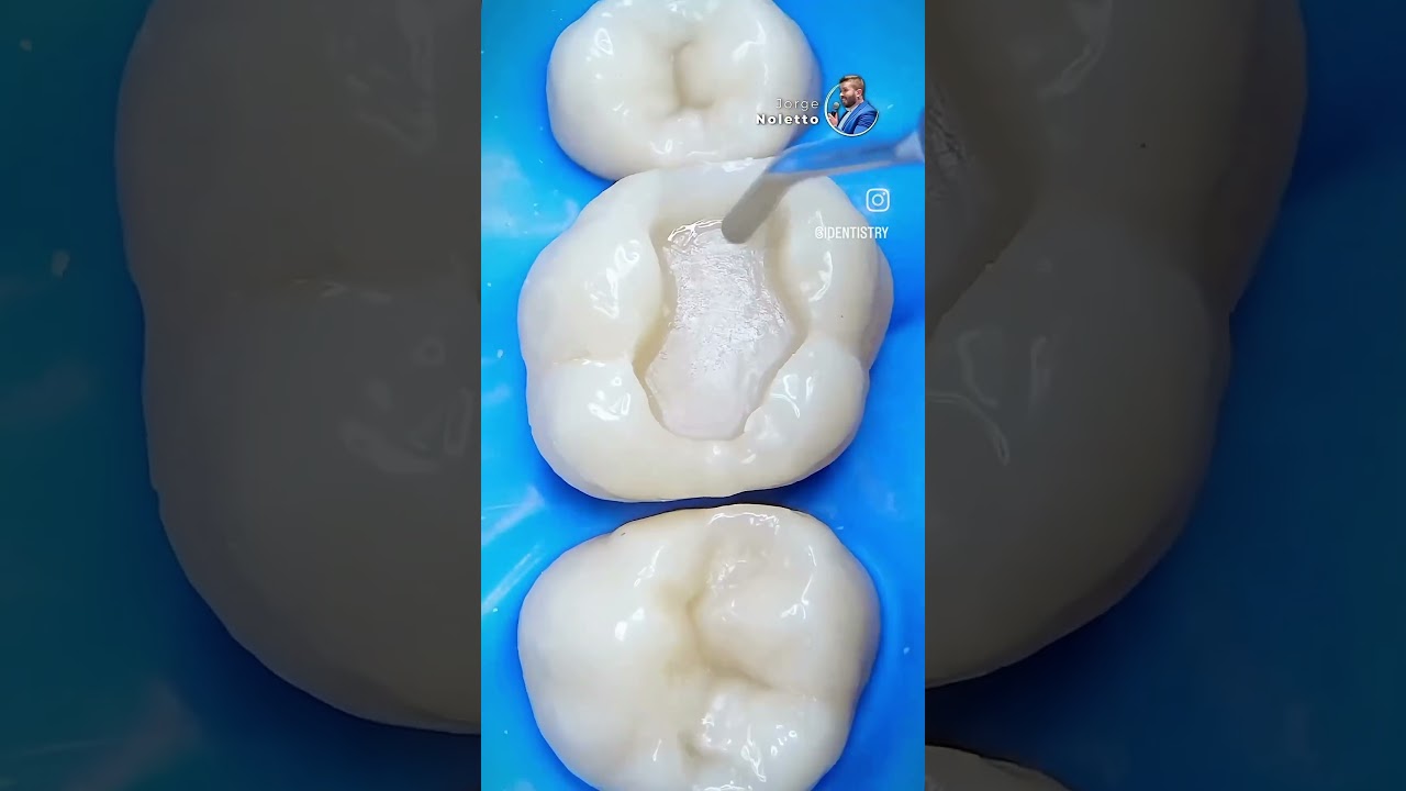 Proximal wall build up || Dr. Jorge leontte