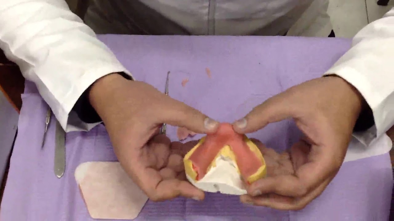 Special tray construction - Light cure acrylic resin