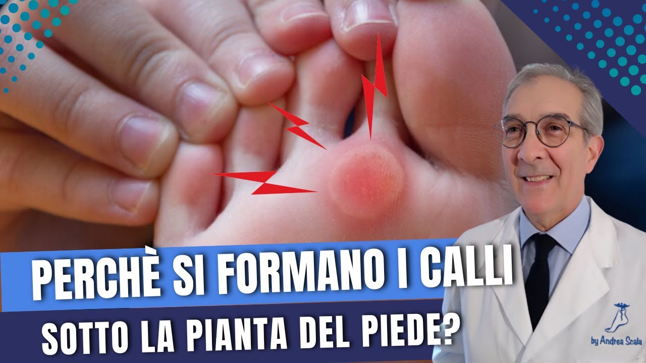 Perchè si formano i calli sotto la pianta del piede? | Dott. Andrea Scala