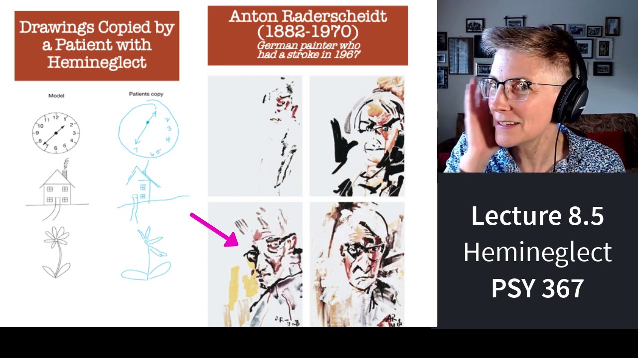 367 Lecture 8.5 Hemineglect