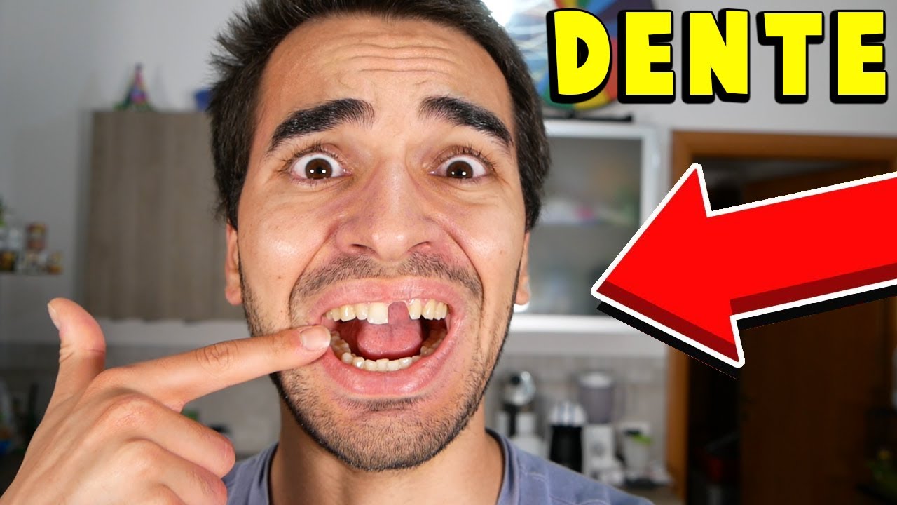 MI SI È ROTTO UN DENTE!!