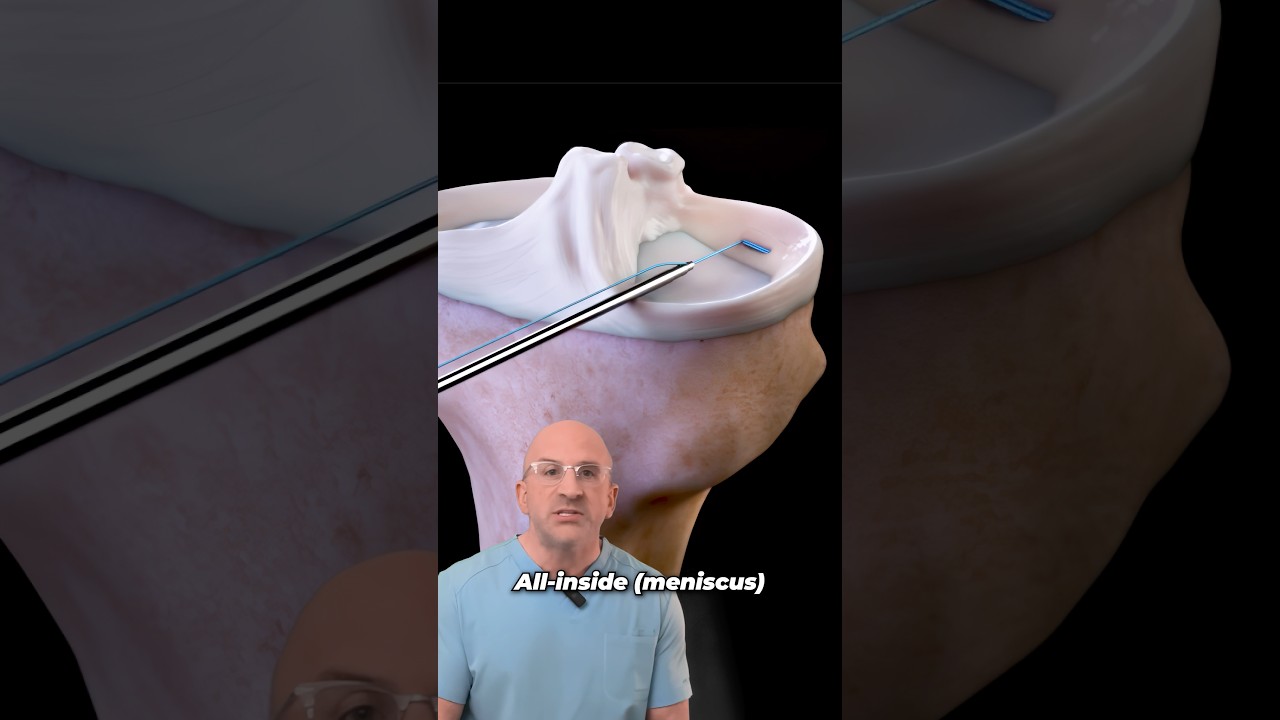 Ingenious Meniscus Tear Repair With Faster Recovery⁉️