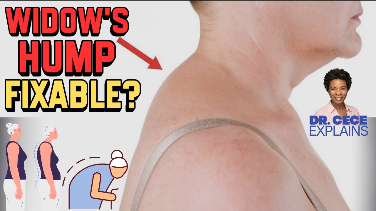 How to Correct Dowager’s Hump and Hyper-Kyphosis | What Causes It & How to Fix It