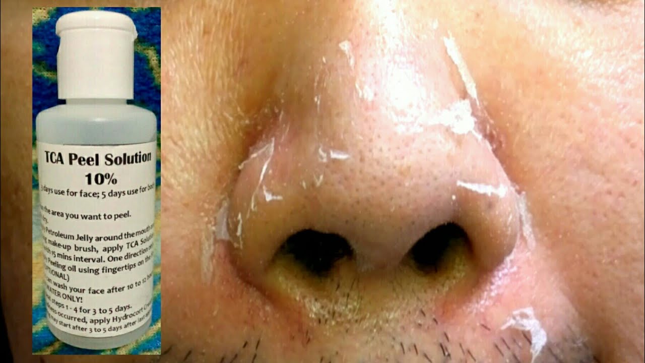 TCA Peel Solution 10% Review & Demo | Before & After