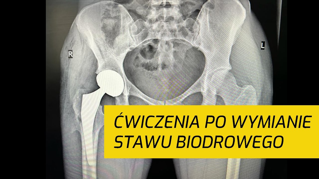 🦴 27-LETNI SPORTOWIEC PO WYMIANIE STAWU BIODROWEGO 🦴 REHABILITACJA