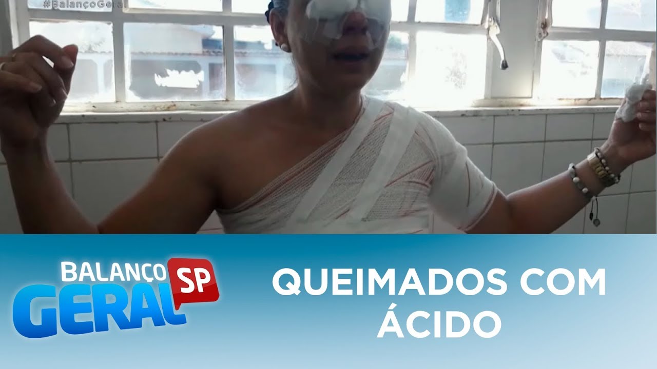 Mulher queima ex-esposa do atual marido com ácido