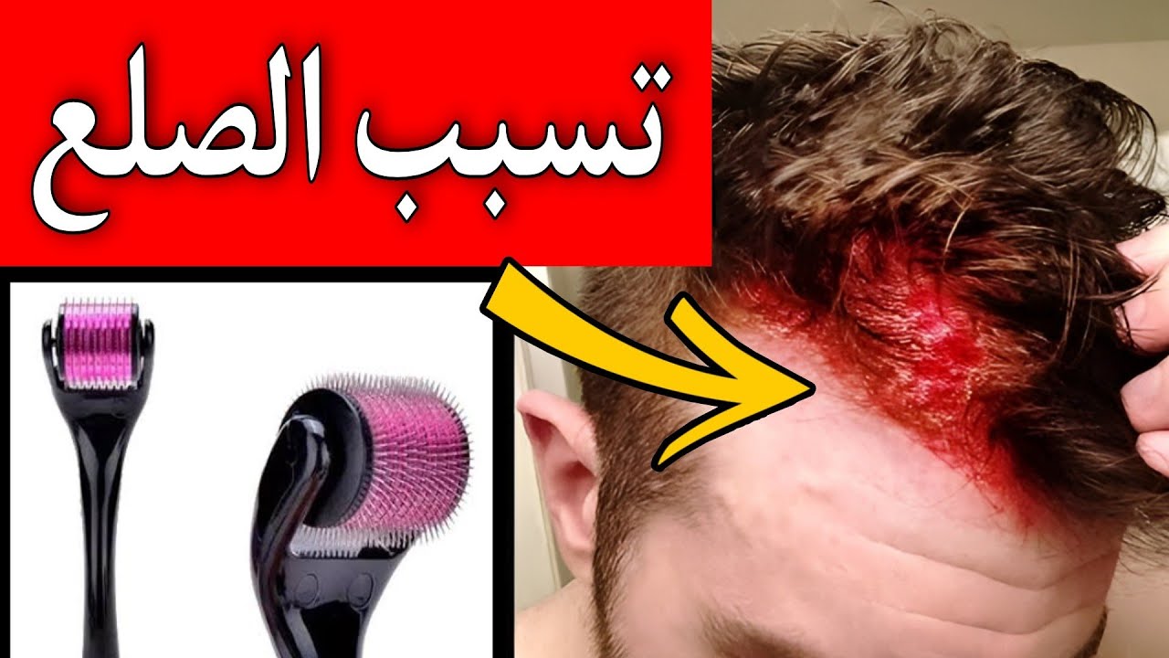 الديرما رولر تسبب الصلع و تساقط الشعر وبالدليل ( ڤيديو هام و عاجل )