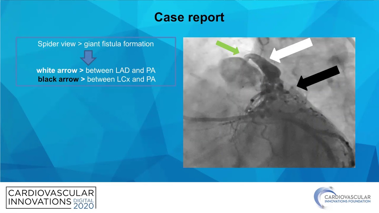 Calik Percutaneous Closure of a Complex Fistula which Originates_Coronary