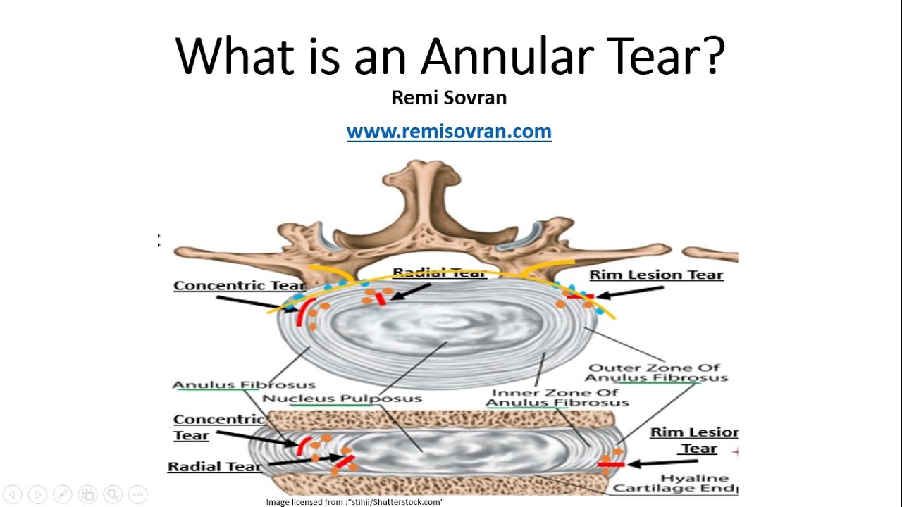 What is an Annular Tear & Why It Is Important for You to Understand