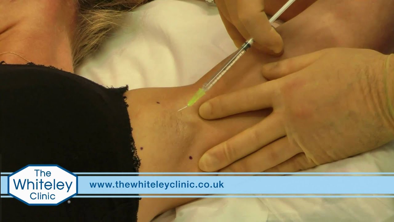 Armpit sweating (axillary hyperhidrosis) treated with Botulinum Toxin A