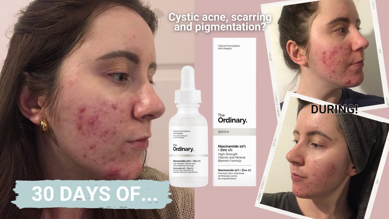 30 DAYS OF…The Ordinary Niacinamide and Zinc | ONE MONTH REVIEW