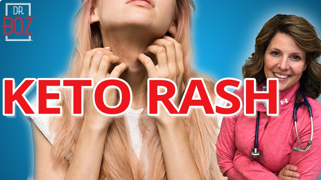 Why do you get Keto Rash? and how to Cure it! | Dr. Boz