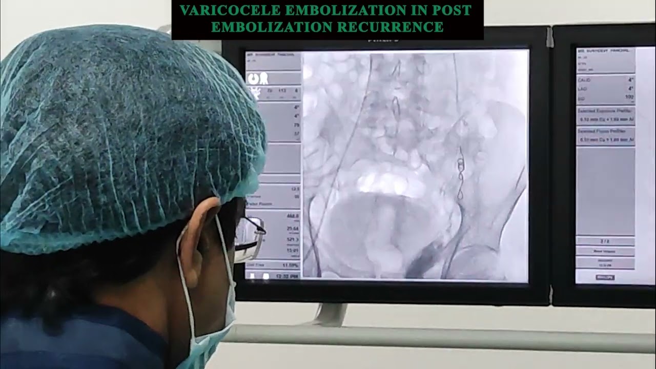 Varicocele Embolization in Post Embolization Recurrence | #doctor #varicoceletreatment #varicocele