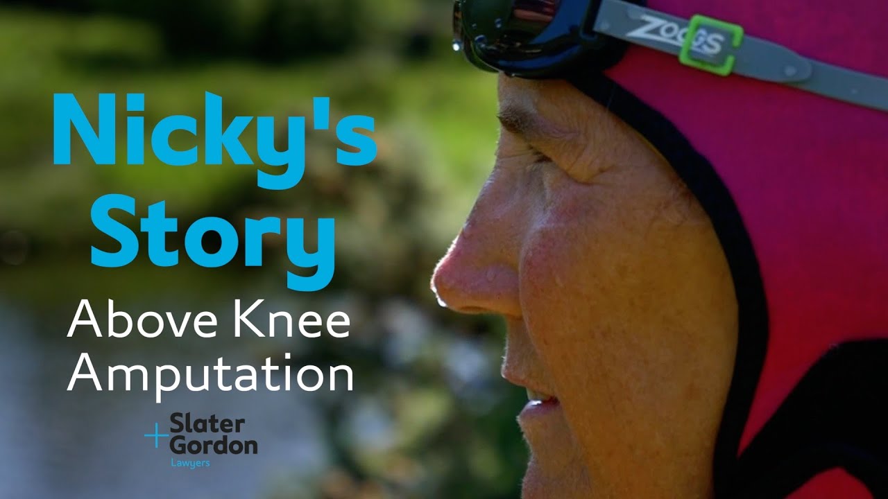 Above Knee Amputation: Nicky's story