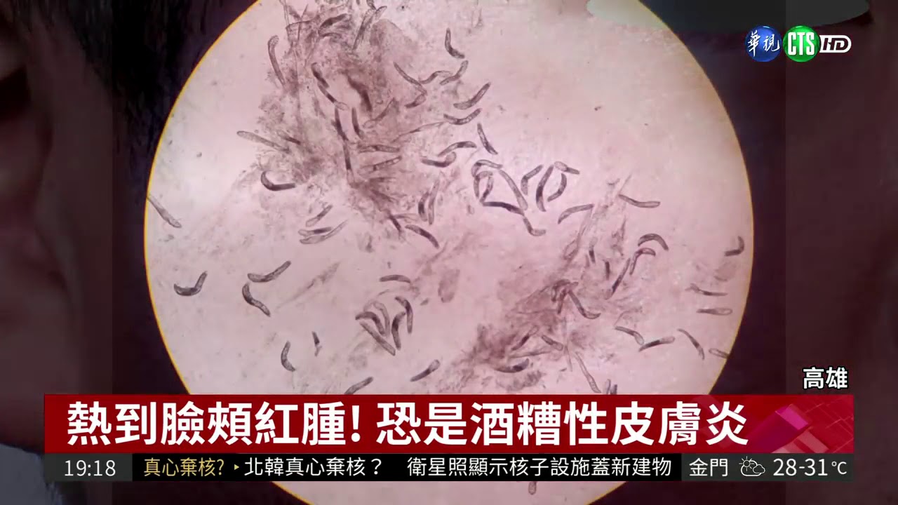 「熱」出病！蟎蟲爬臉害酒糟性皮膚炎