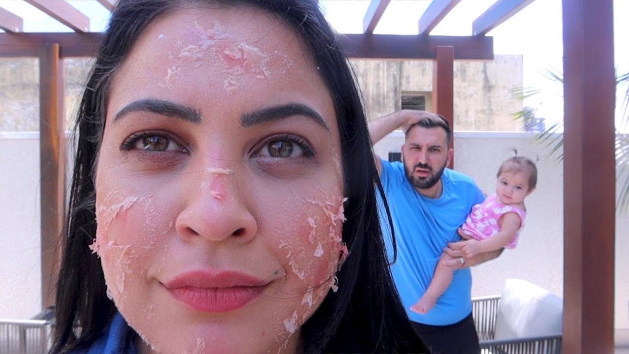 مقلب وجهي تشوه واحترق !! ردة فعل زوجي
