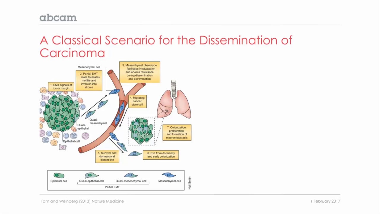 Cancer: Epithelial mesenchymal transition in carcinoma (2/11)